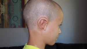 microtia
